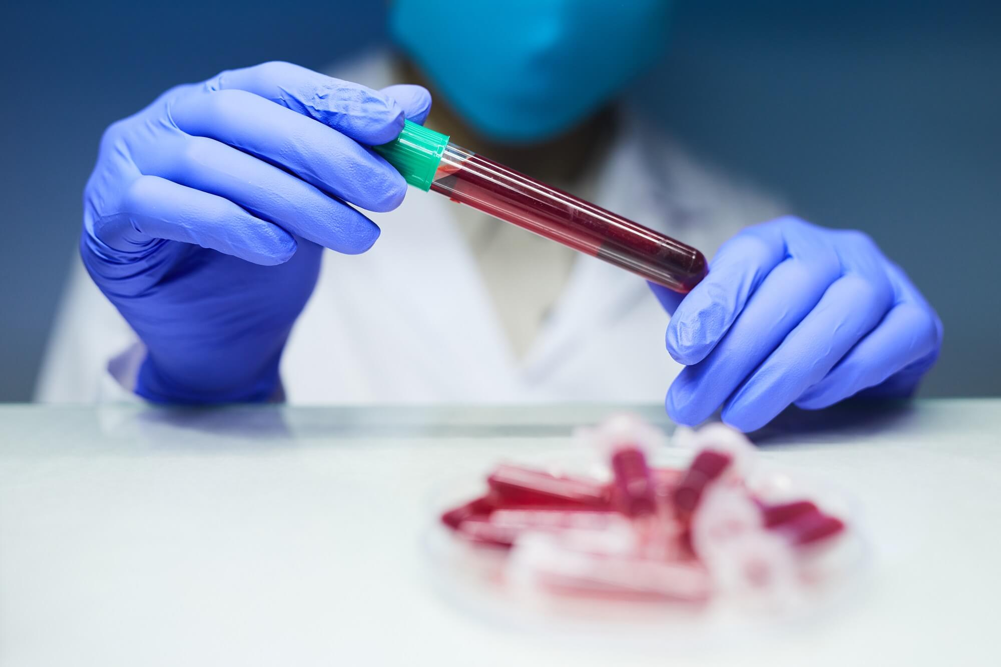 pathologist holding test tube with blood sample